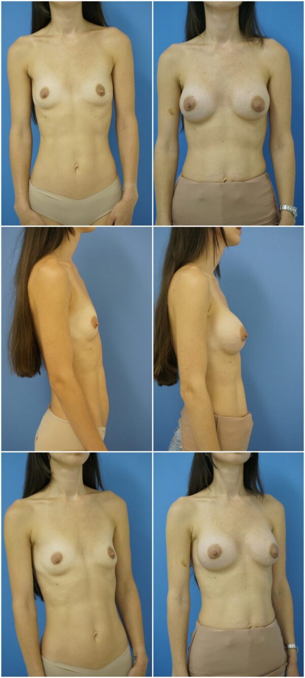 Before and After Image: Breast Augmentation - other