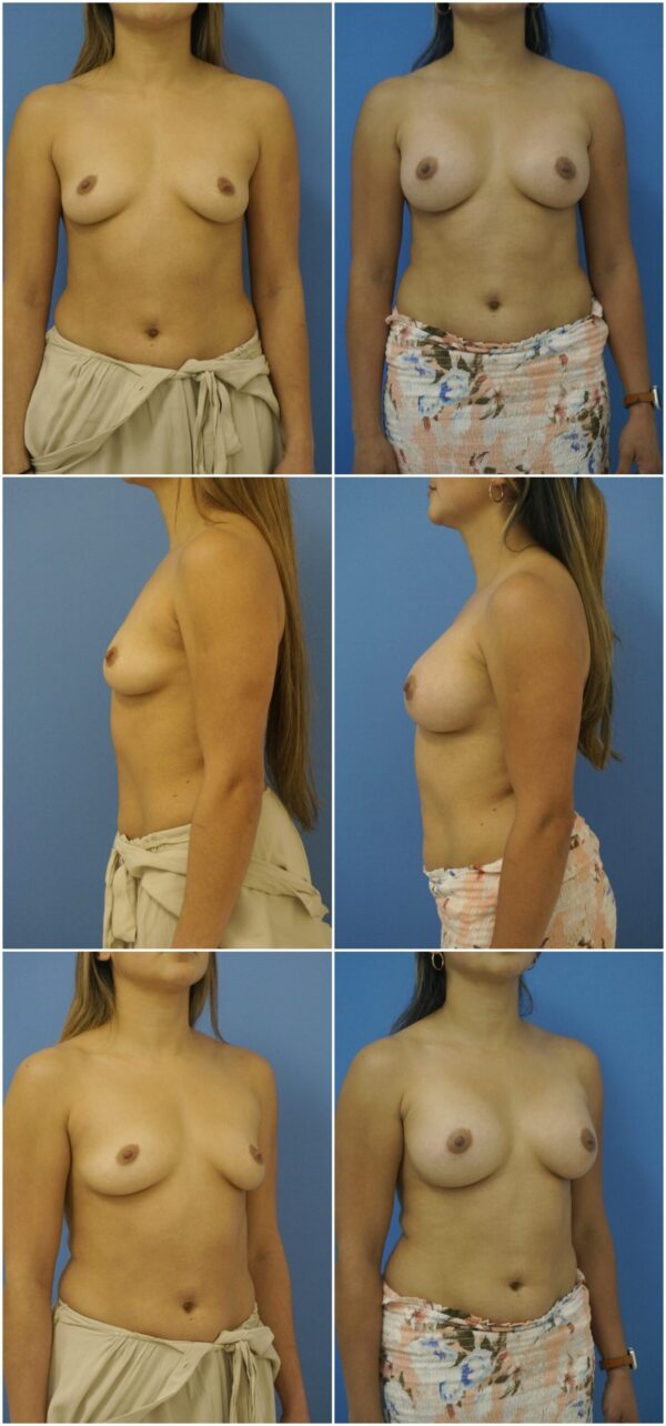 Before and After Image: Breast Augmentation - other