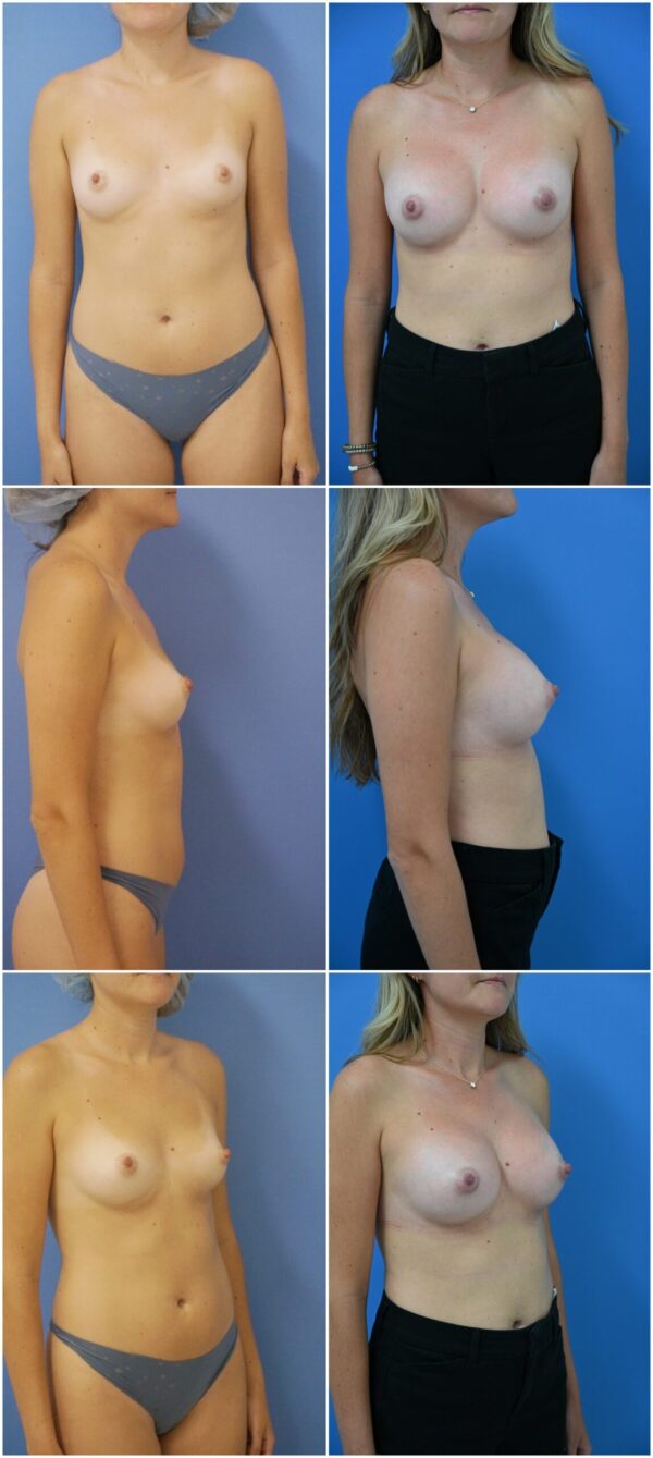 Before and After Image: Breast Augmentation - other