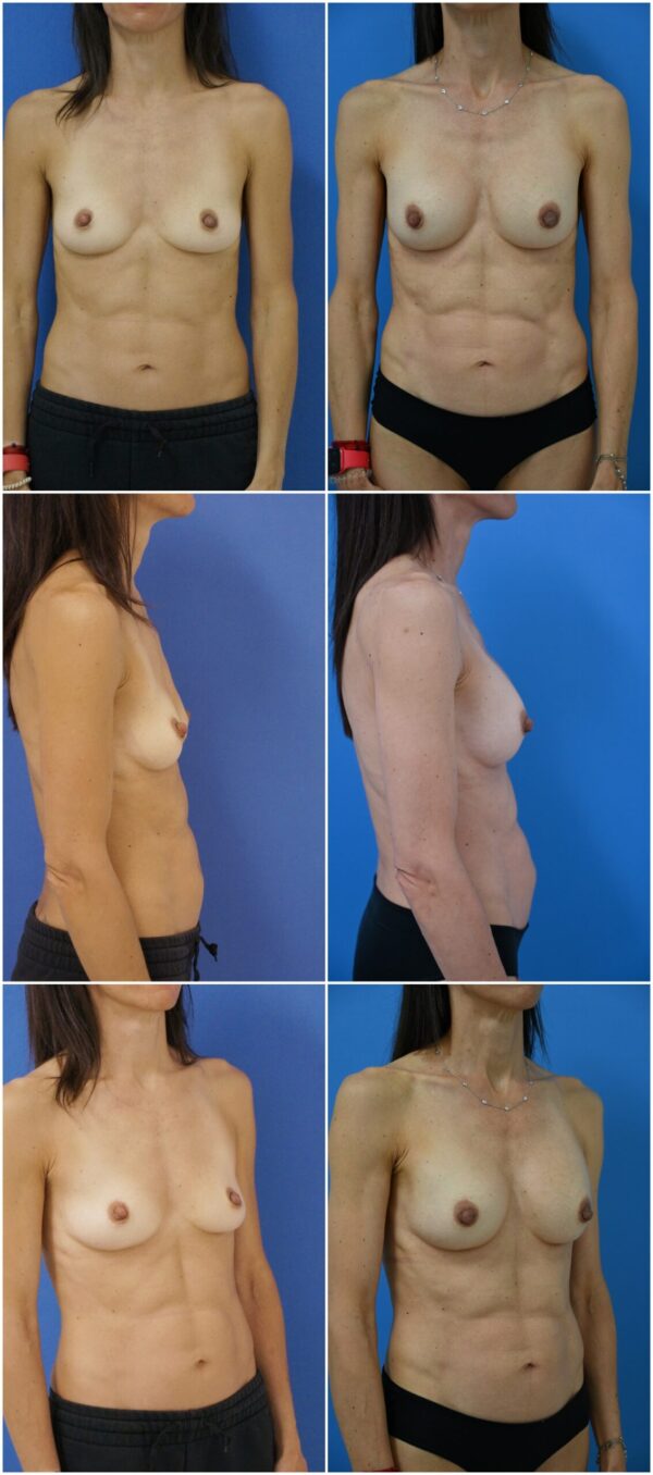 Before and After Image: Breast Augmentation - other