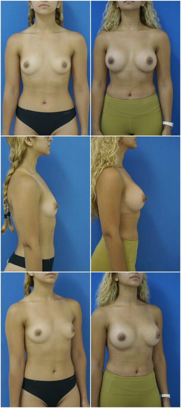 Before and After Image: Breast Augmentation - other