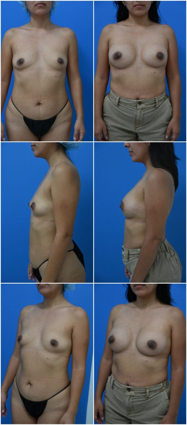 Before and After Image: Breast Augmentation - other