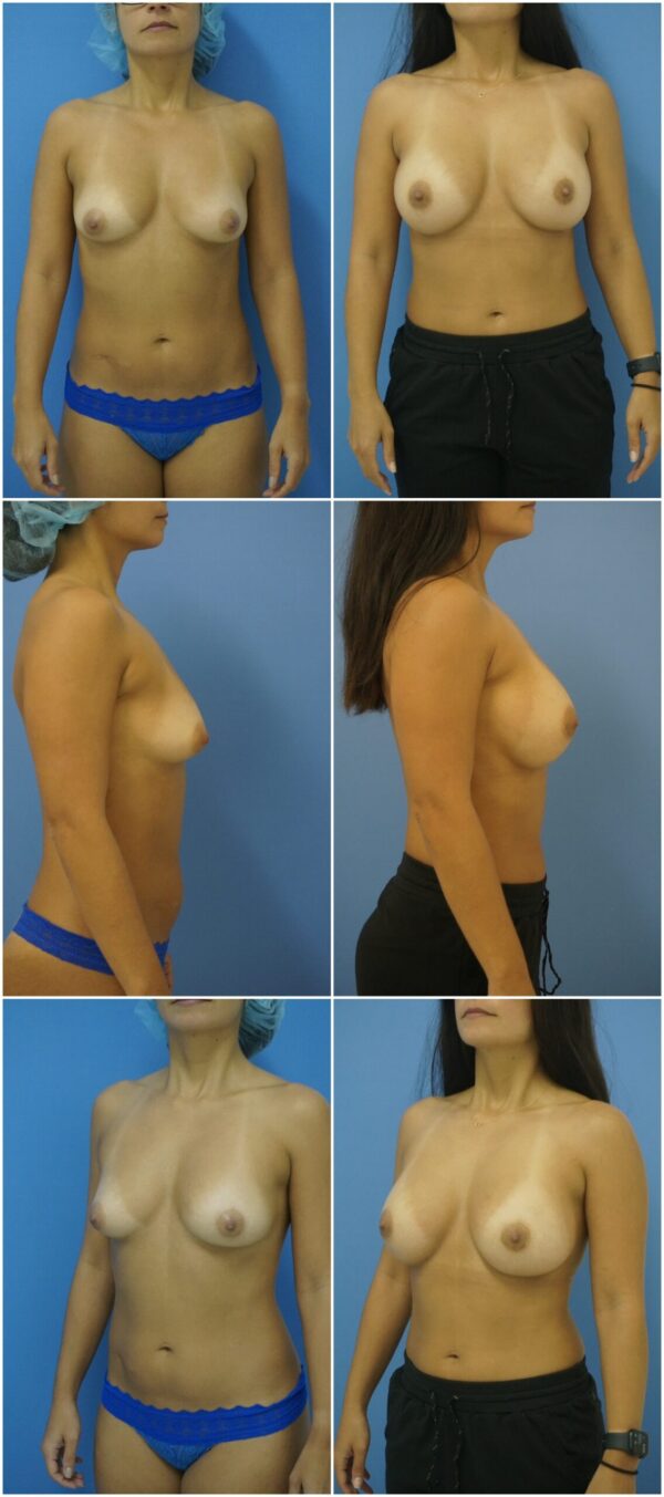 Before and After Image: Breast Augmentation - other