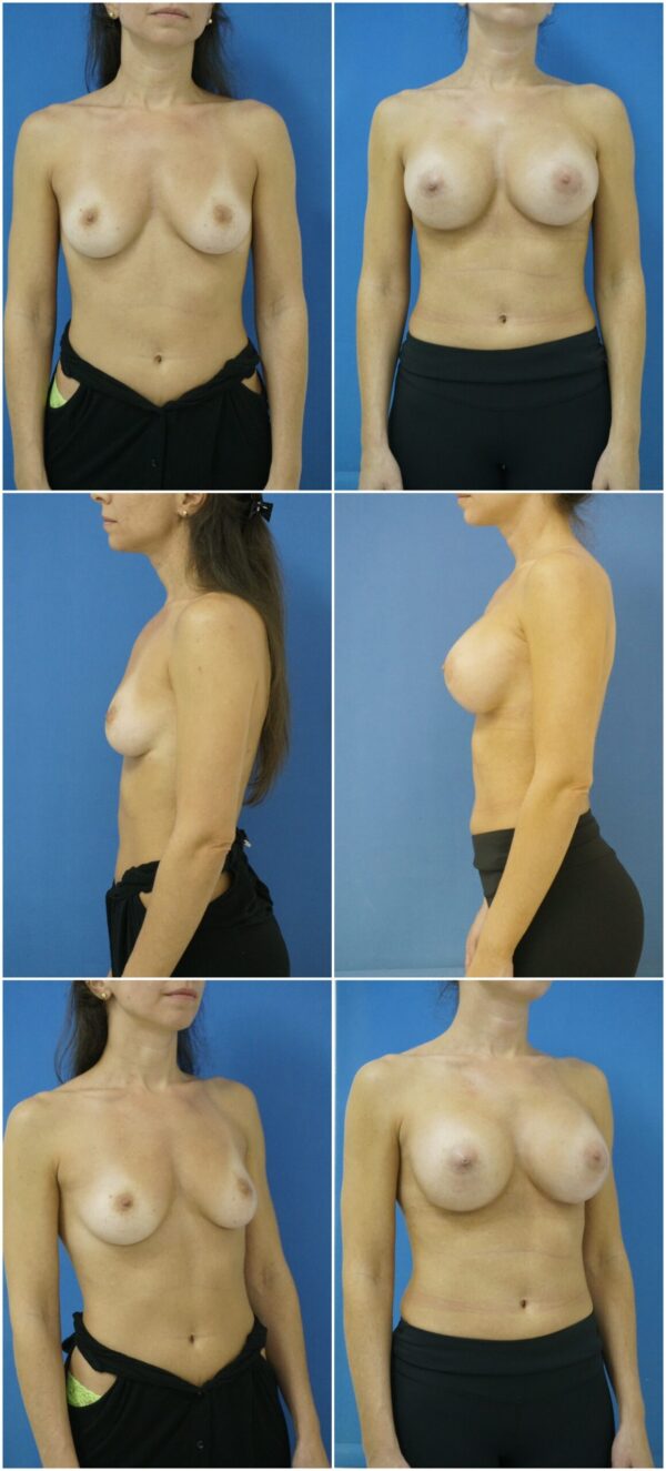 Before and After Image: Breast Augmentation - other