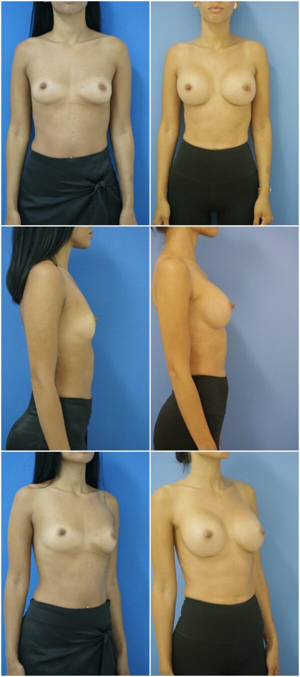 Before and After Image: Breast Augmentation - other