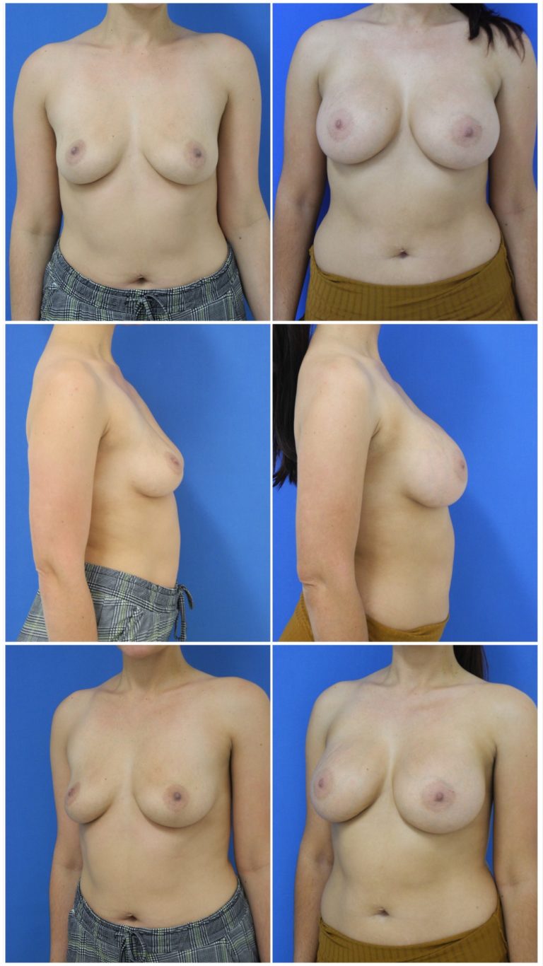 Before and After Image: Breast Augmentation - other