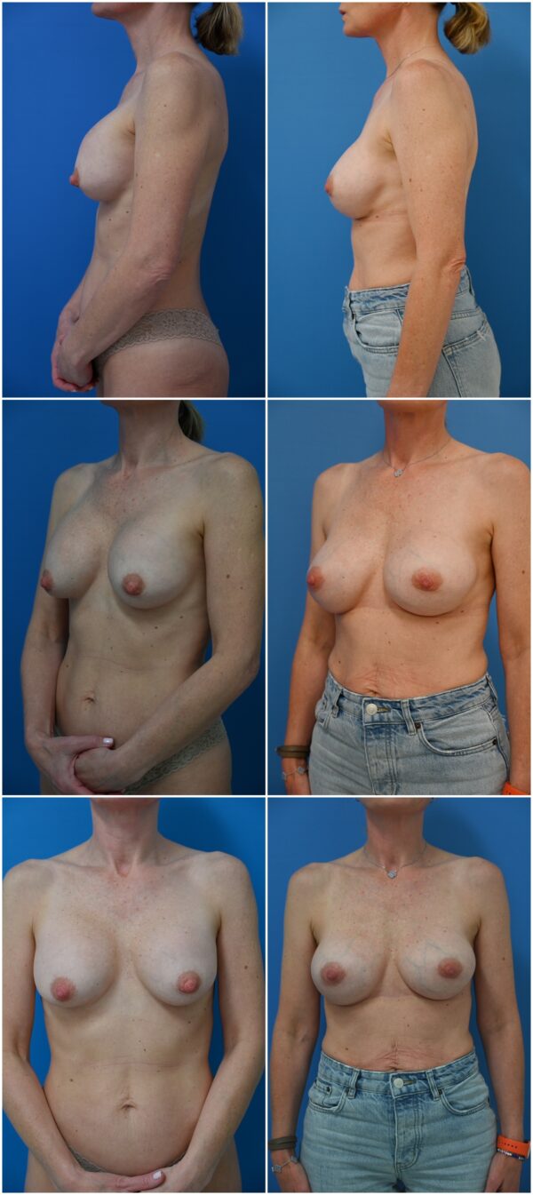Before and After Image: Breast Implant Revision - other