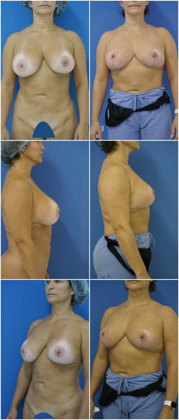 Before and After Image: Breast Lift - other