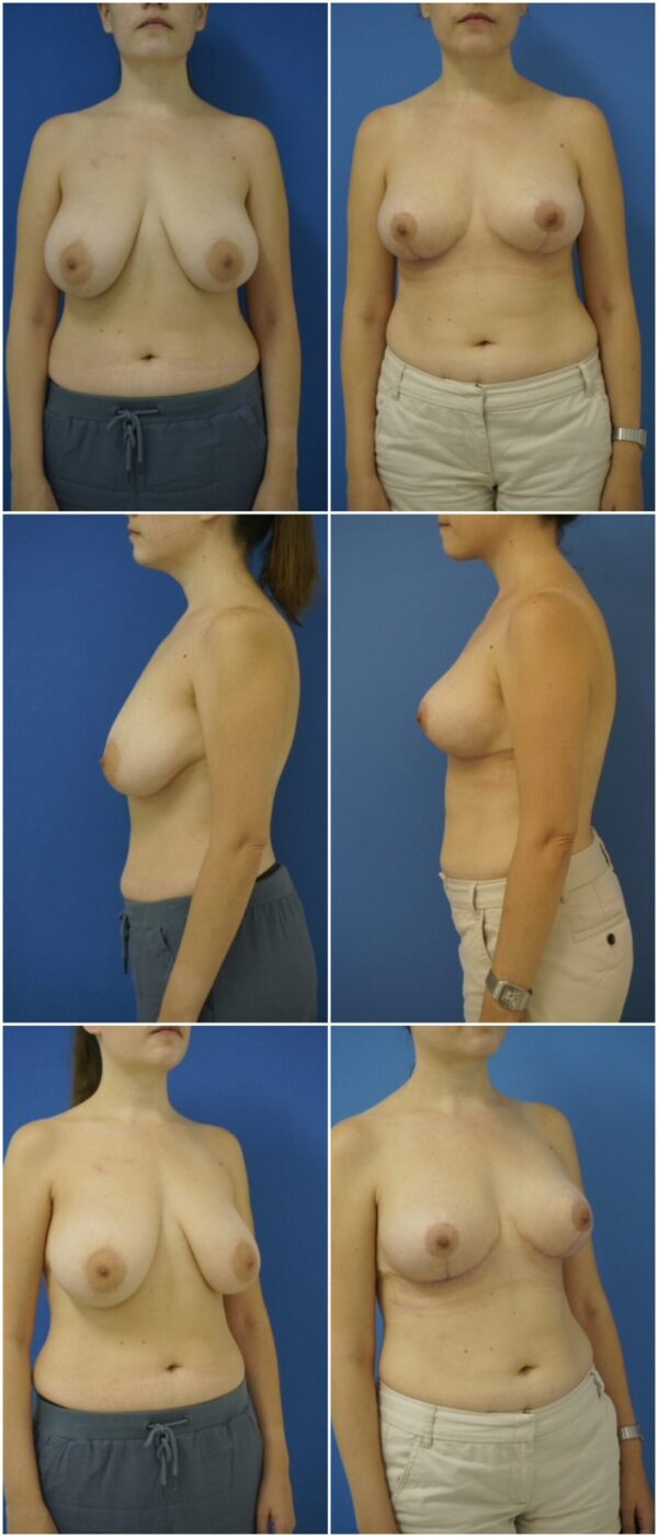 Before and After Image: Breast Lift - other