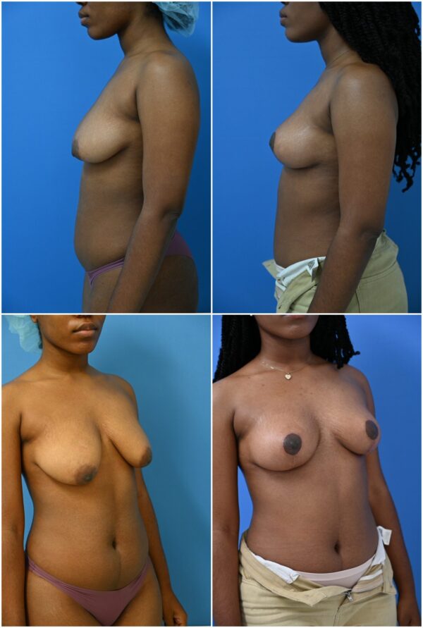 Before and After Image: Breast Lift - other