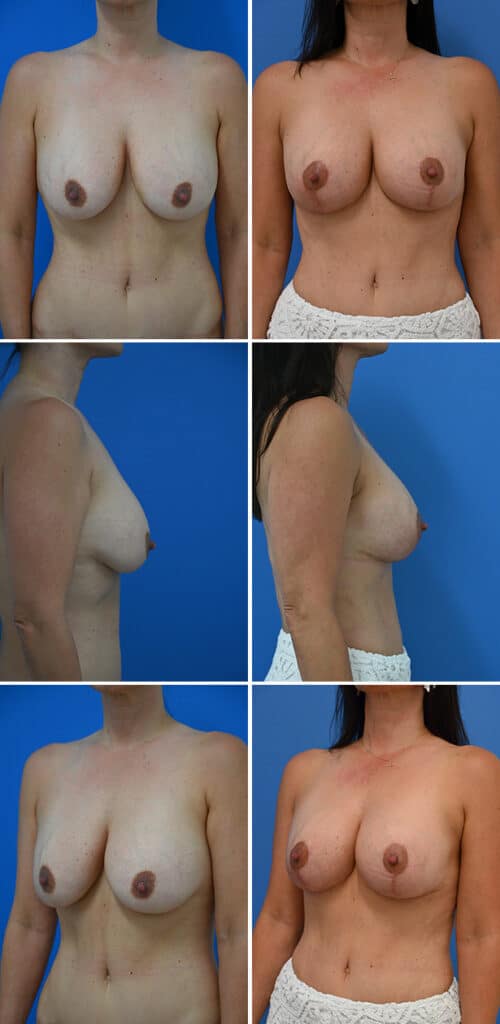 Before and After Image: Breast Augmentation with Lift - other