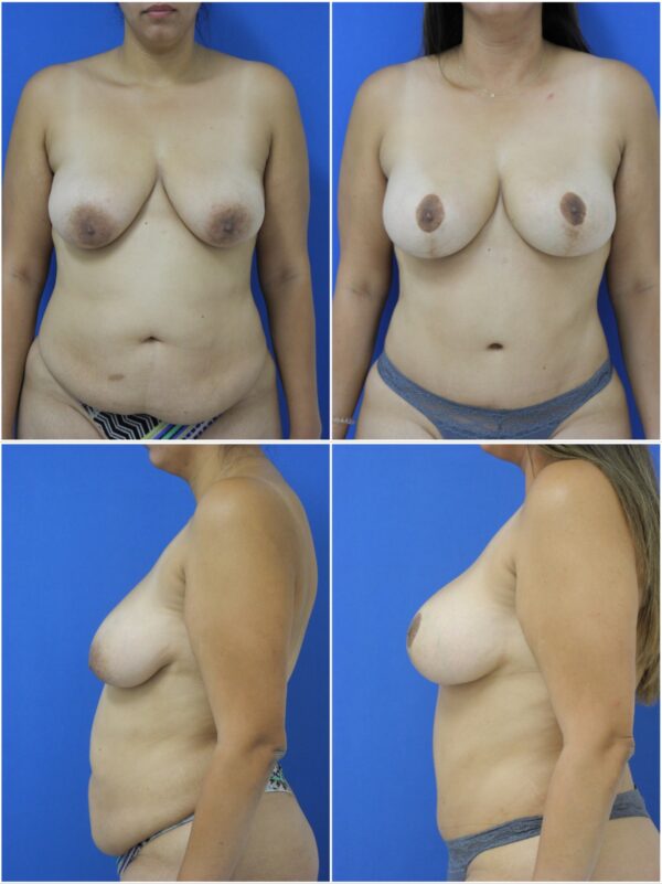 Before and After Image: Breast Lift - other