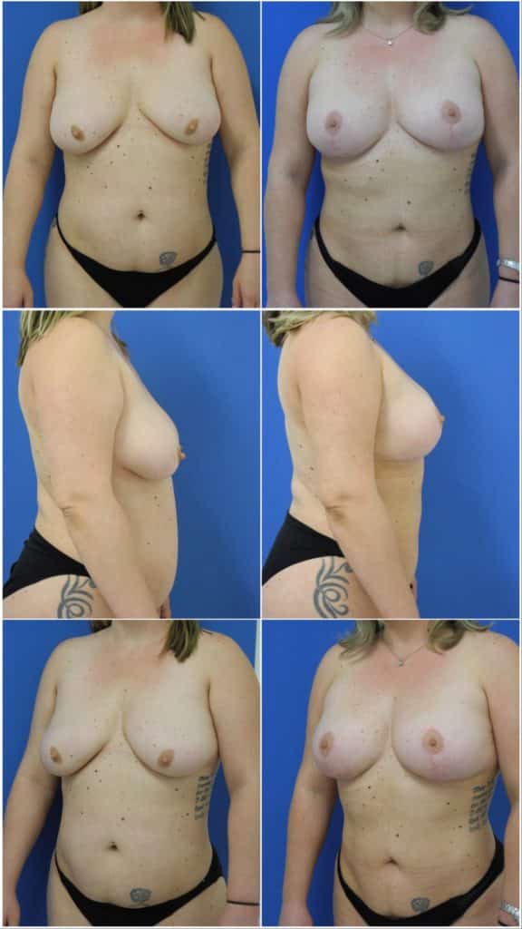 Before and After Image: Breast Lift - other