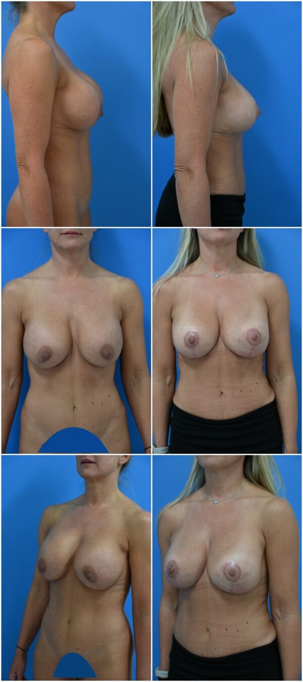 Before and After Image: Breast Augmentation with Lift - other