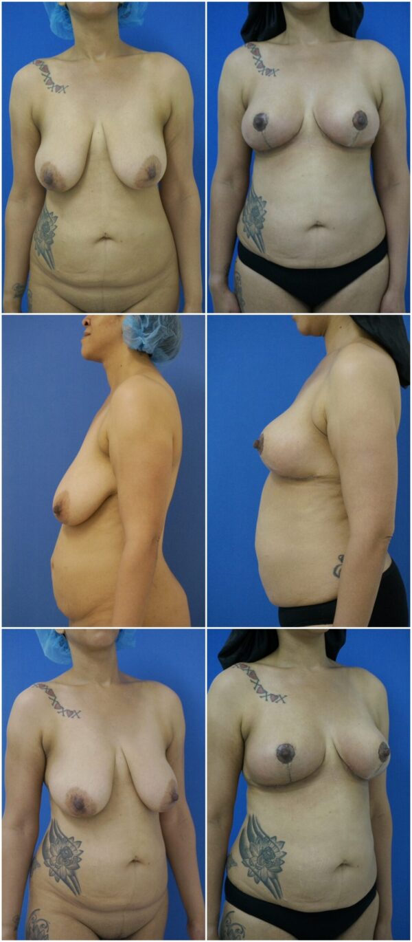 Before and After Image: Breast Lift - other