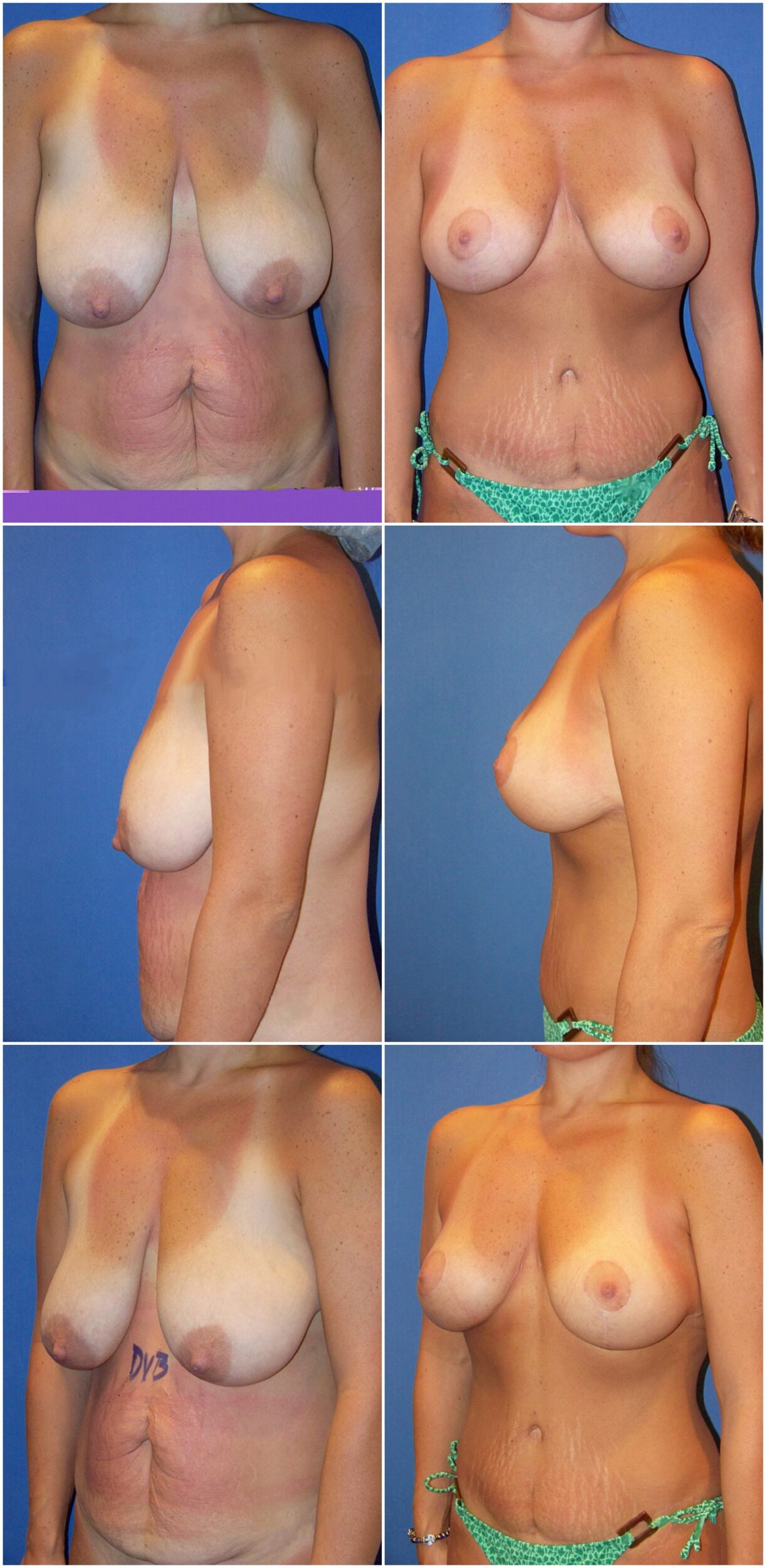 Before and After Image: Tummy Tuck (Abdominoplasty) - other