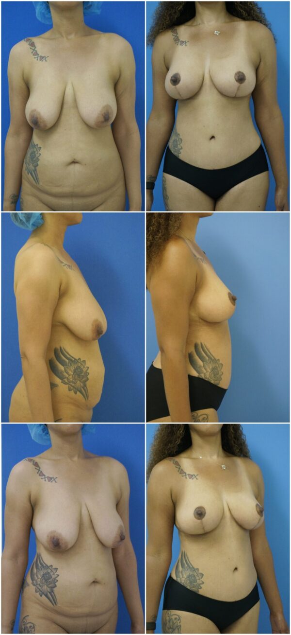 Before and After Image: Breast Lift - other