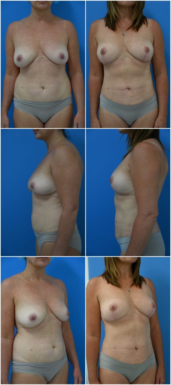 Before and After Image: Breast Lift - other
