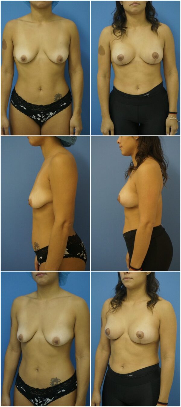 Before and After Image: Breast Augmentation with Lift - other