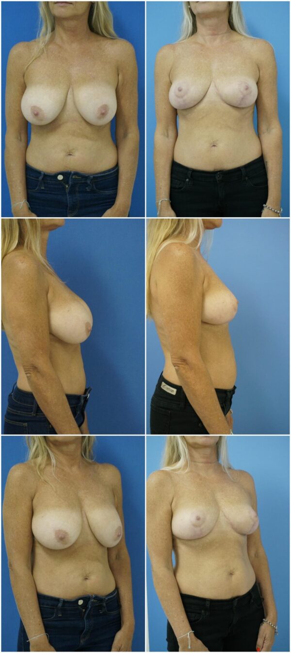 Before and After Image: Breast Lift - other