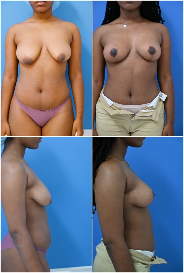 Before and After Image: Breast Lift - front
