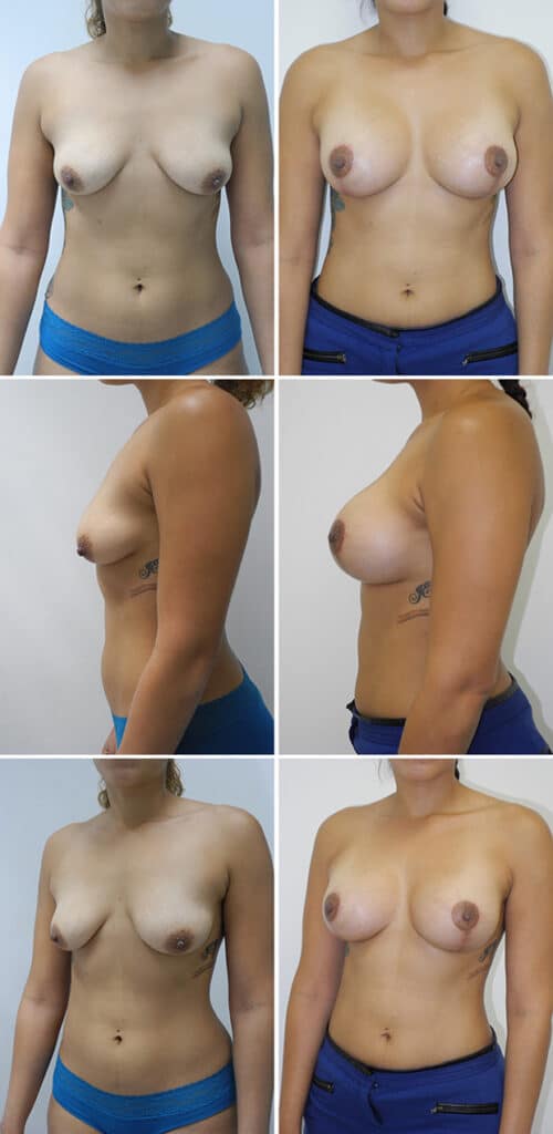 Before and After Image: Breast Augmentation with Lift - other