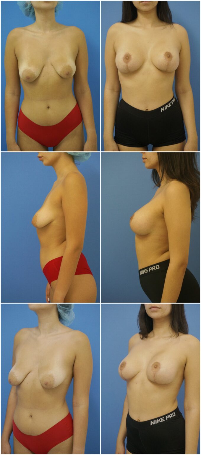 Before and After Image: Breast Augmentation with Lift - other