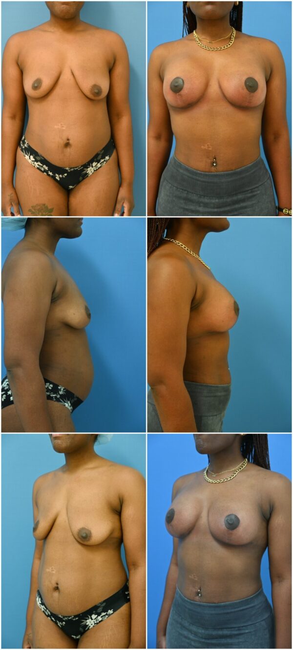 Before and After Image: Breast Augmentation with Lift - other