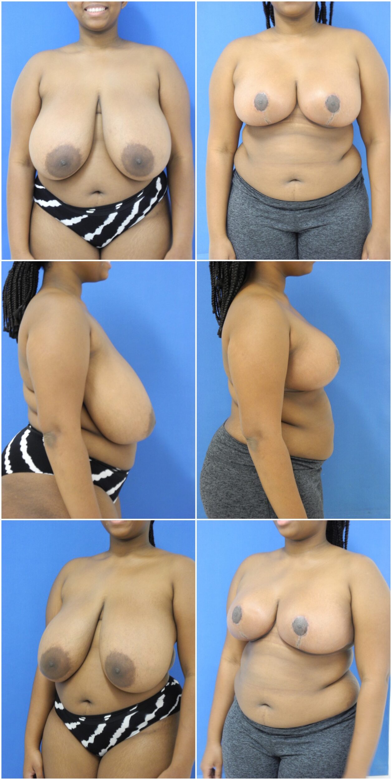 Before and After Image: Breast Reduction Surgery - other