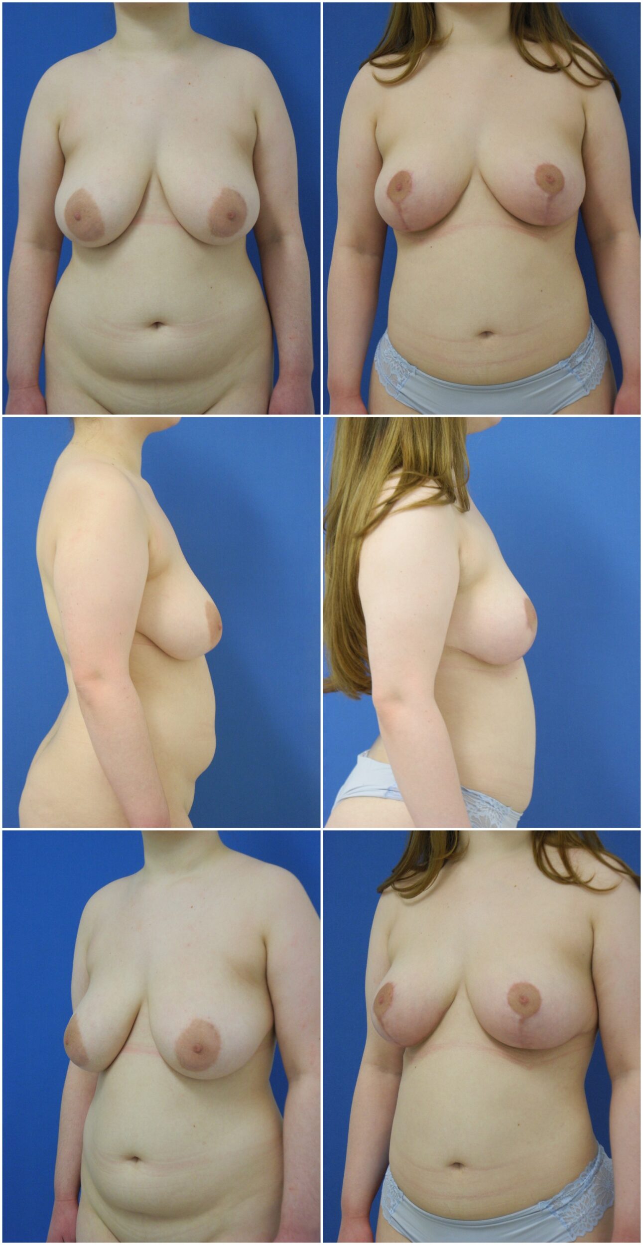Before and After Image: Breast Reduction Surgery - other