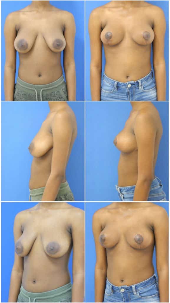 Before and After Image: Breast Reduction Surgery - other