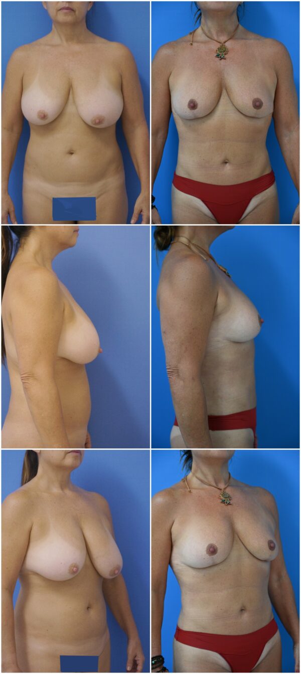 Before and After Image: Breast Reduction Surgery - other