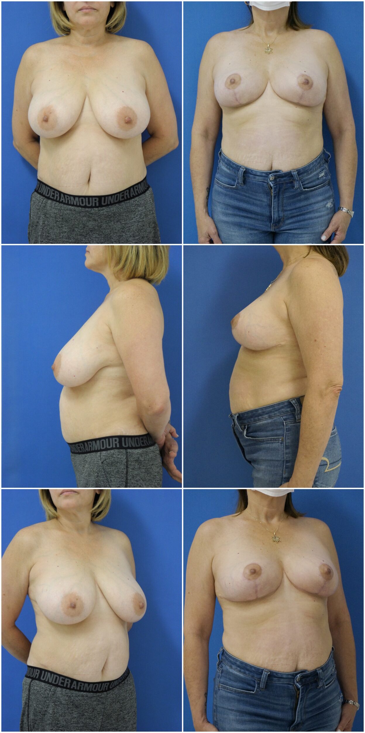 Before and After Image: Breast Reduction Surgery - other