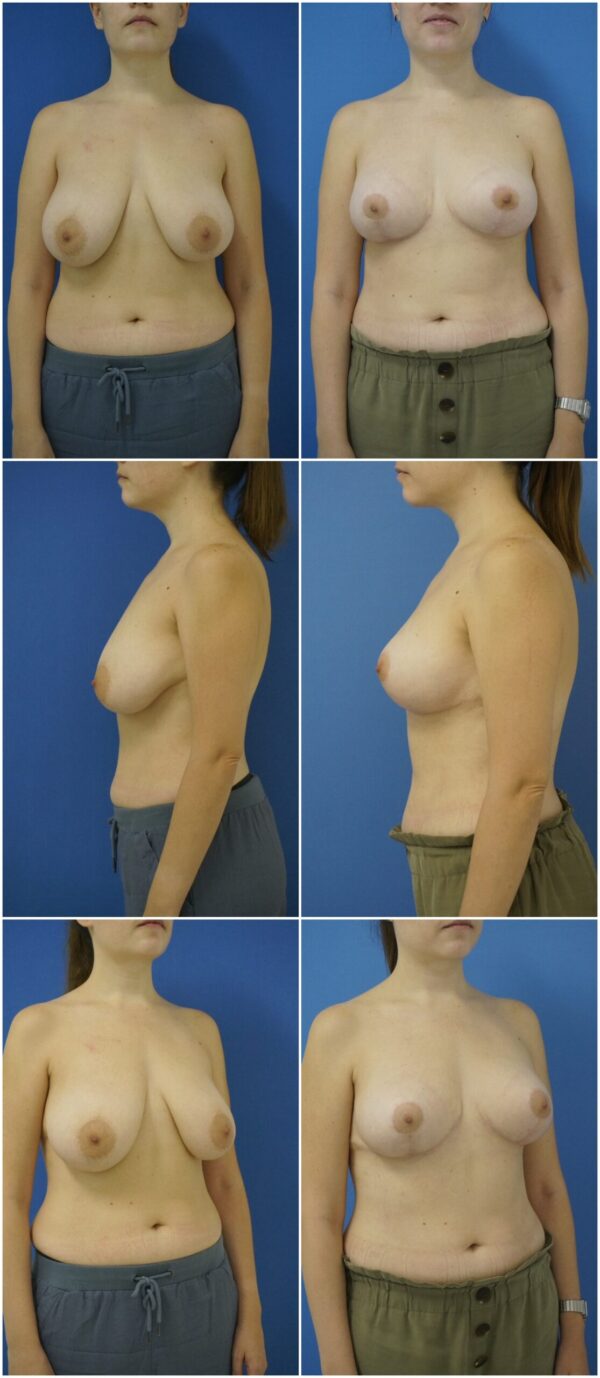 Before and After Image: Breast Reduction Surgery - other