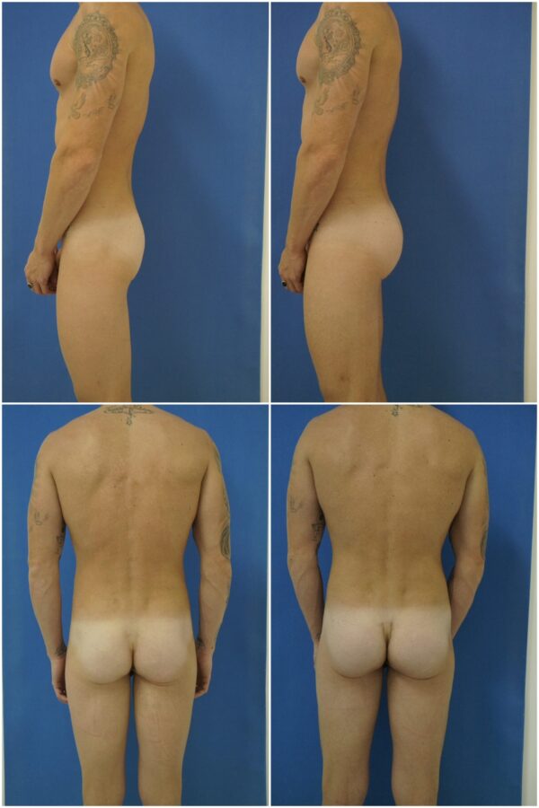 Before and After Image: Butt Augmentation (Implants) - other