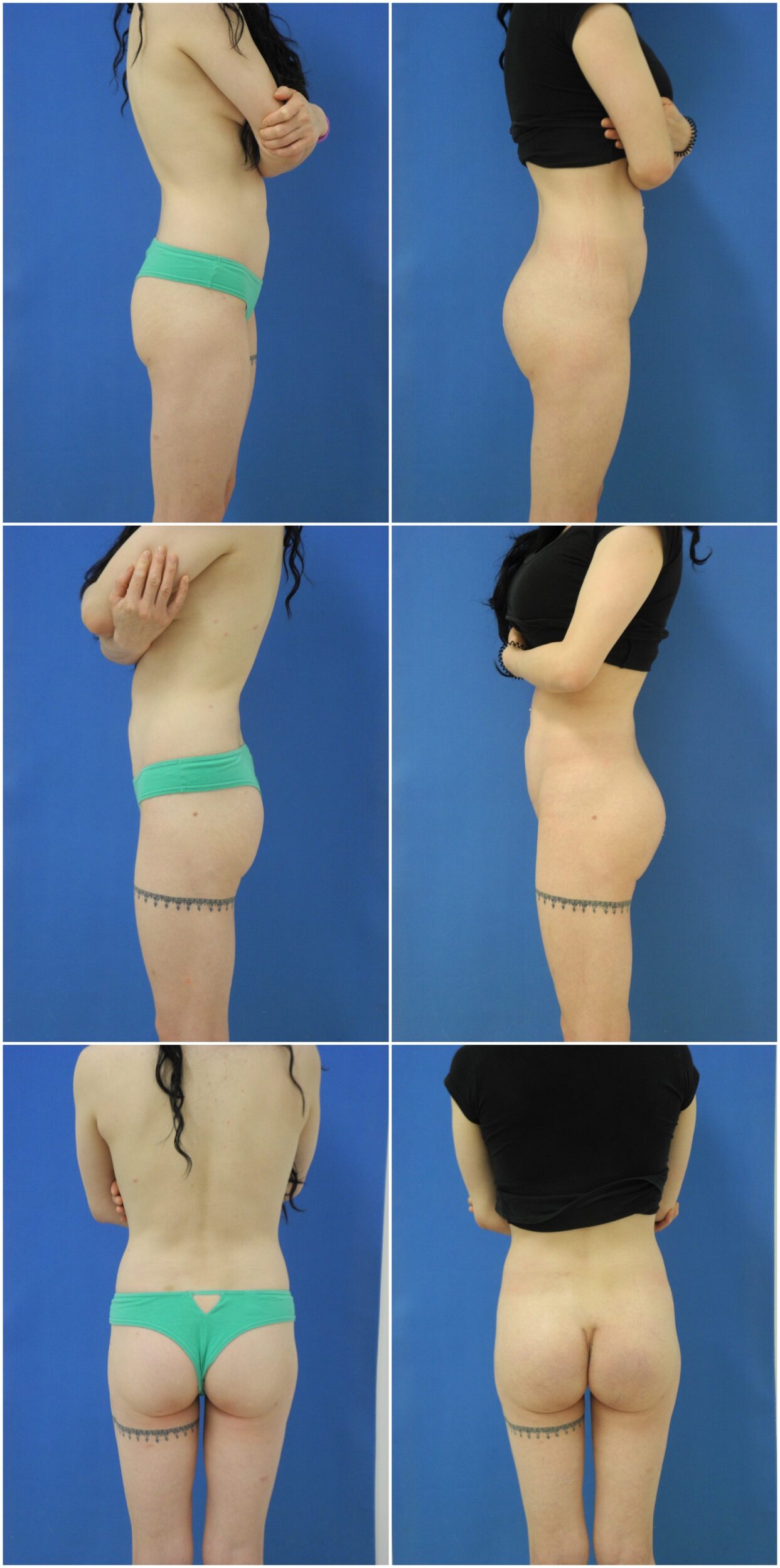 Before and After Image: Butt Augmentation (Implants) - other