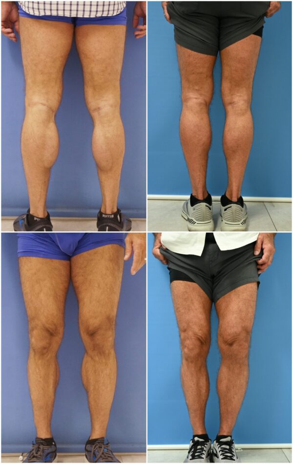 Before and After Image: Calf Augmentation - other