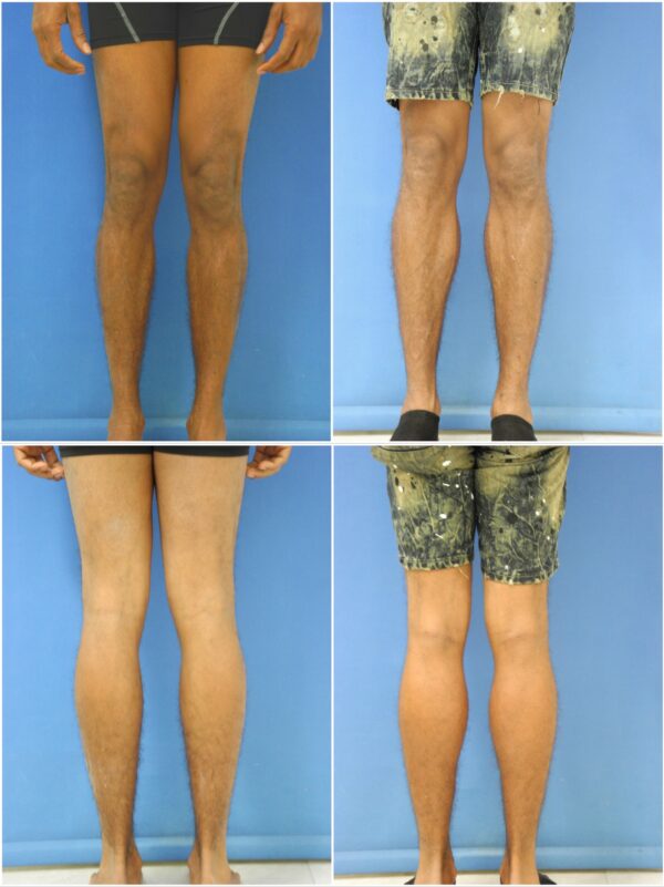Before and After Image: Calf Augmentation - other
