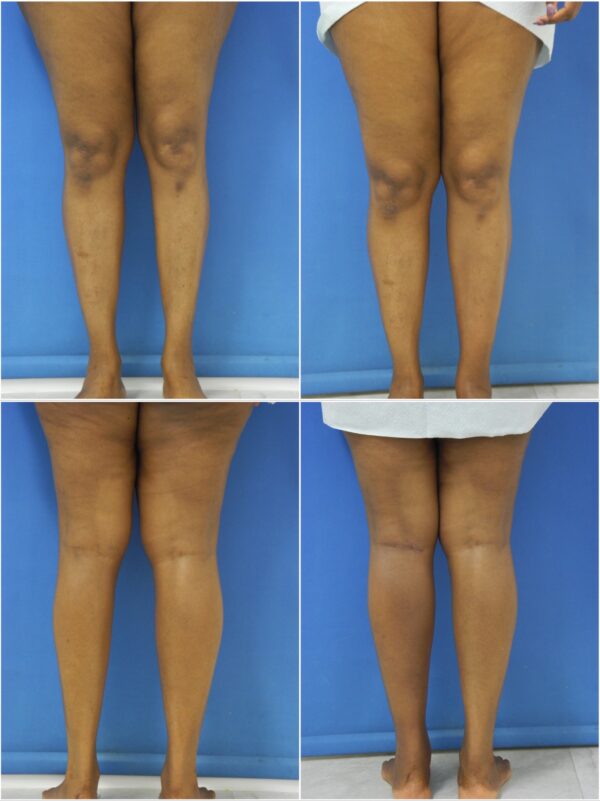Before and After Image: Calf Augmentation - other