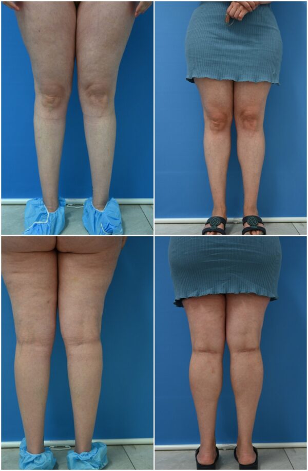 Before and After Image: Calf Augmentation - other