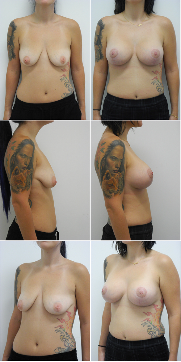 Before and After Image: Breast Augmentation with Lift - other