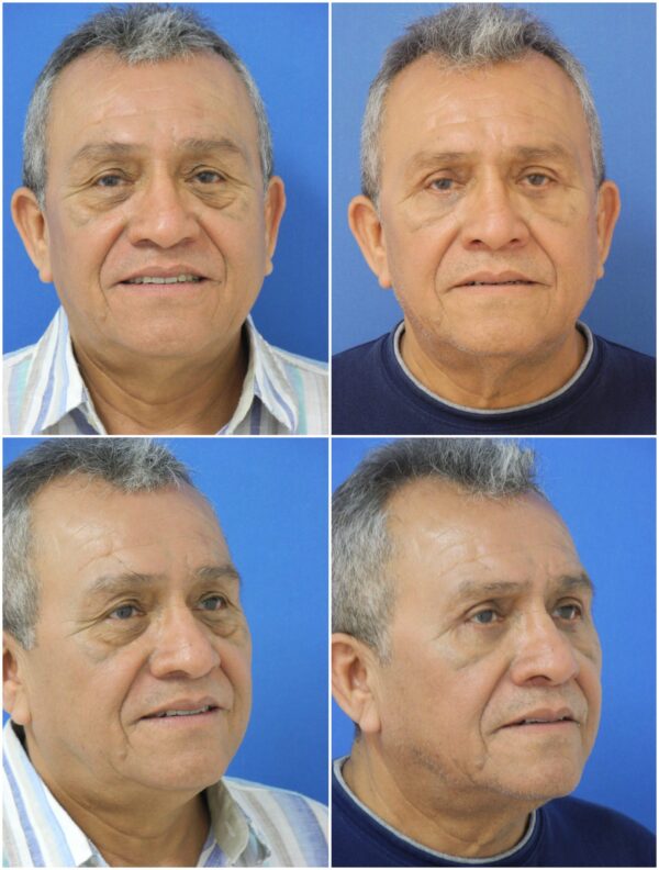 Before and After Image: Eyelid Lift Surgery (Blepharoplasty) - other