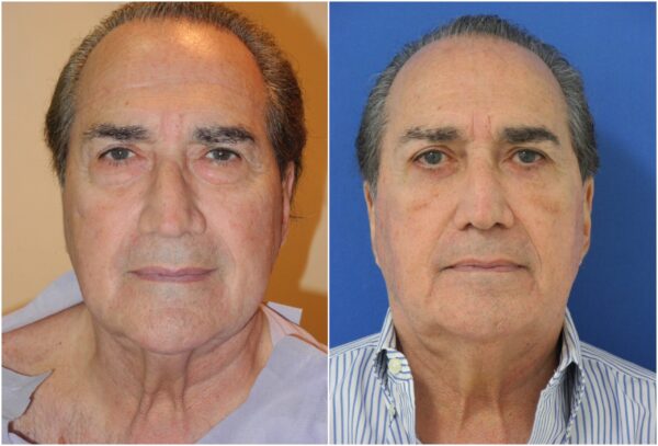 Before and After Image: Eyelid Lift Surgery (Blepharoplasty) - other