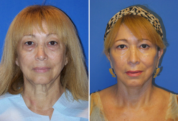 Before and After Image: Eyelid Lift Surgery (Blepharoplasty) - other