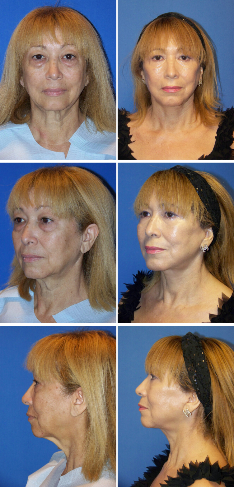 Before and After Image: Facelift Surgery - other