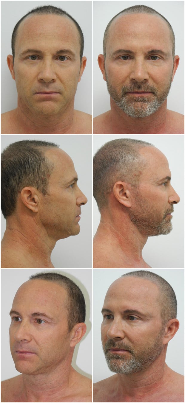 Before and After Image: Facelift Surgery - other