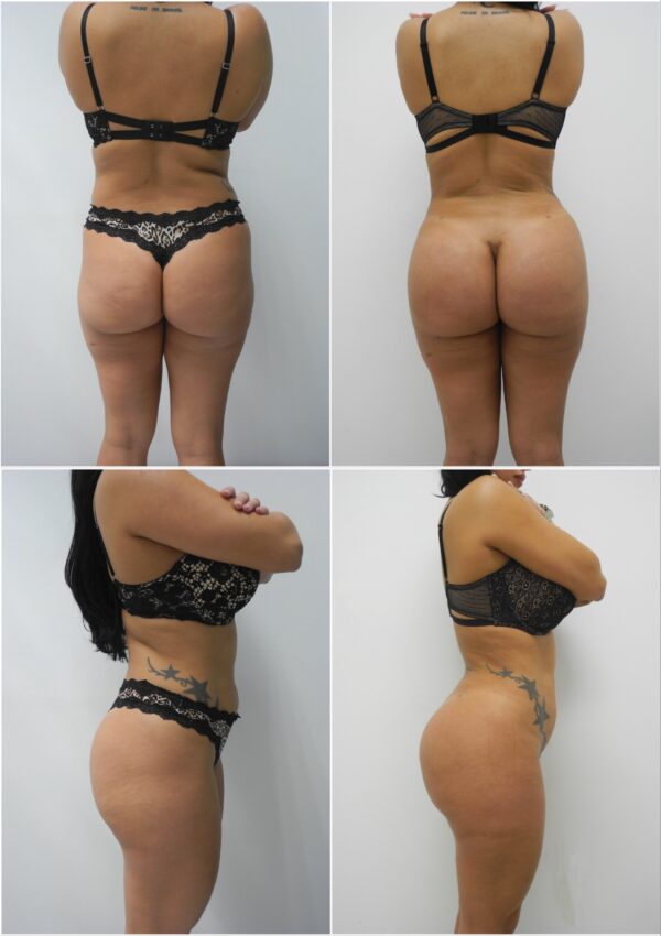 Before and After Image: Butt Augmentation (Implants) - other