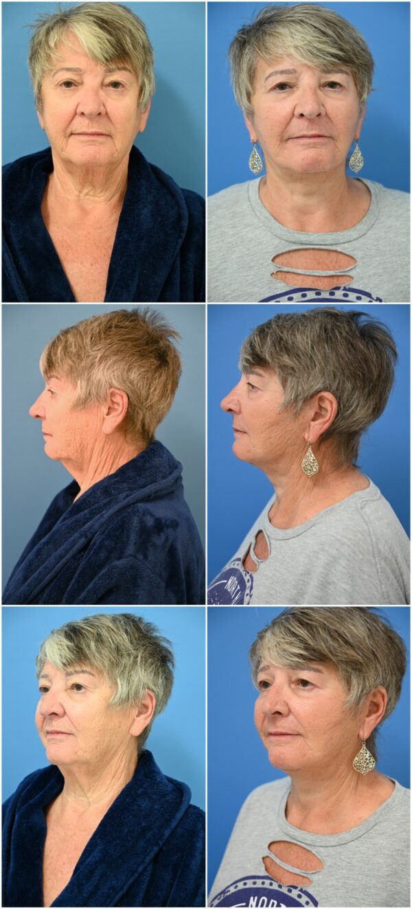 Before and After Image: Facelift Surgery - other
