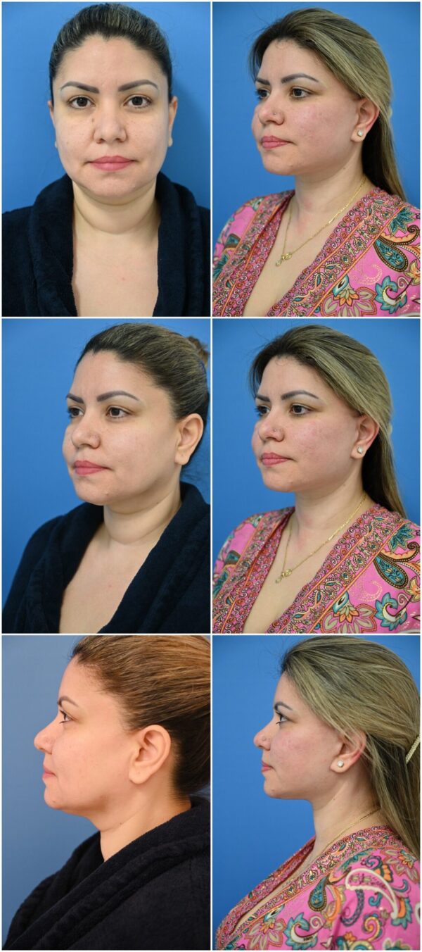 Before and After Image: Facelift Surgery - other