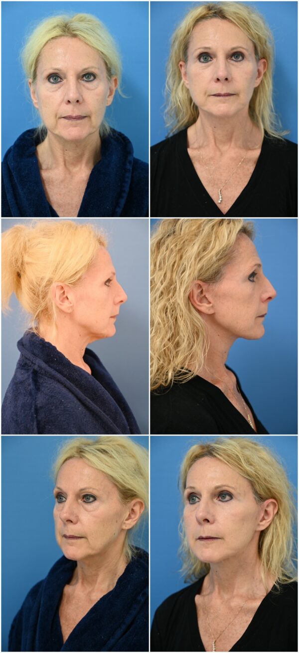Before and After Image: Eyelid Lift Surgery (Blepharoplasty) - other
